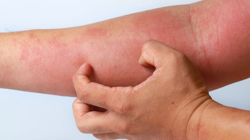 Atopic Dermatitis – The Most Common Skin Problem