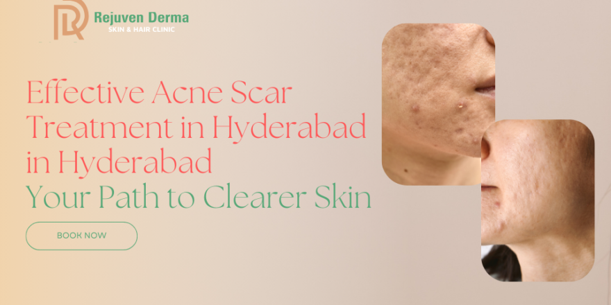 Acne Scars