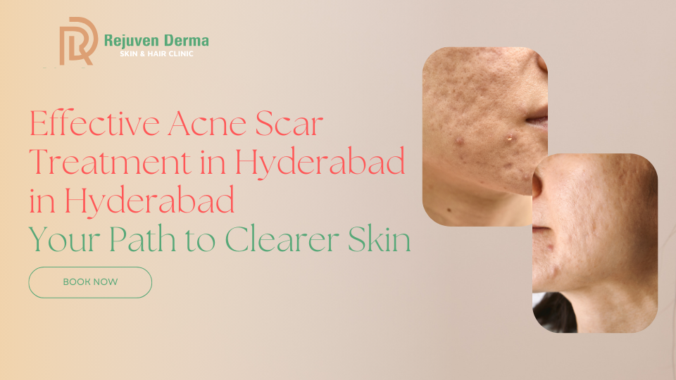 Clearing the Slate: Your Guide to Effective Acne Scar Treatment